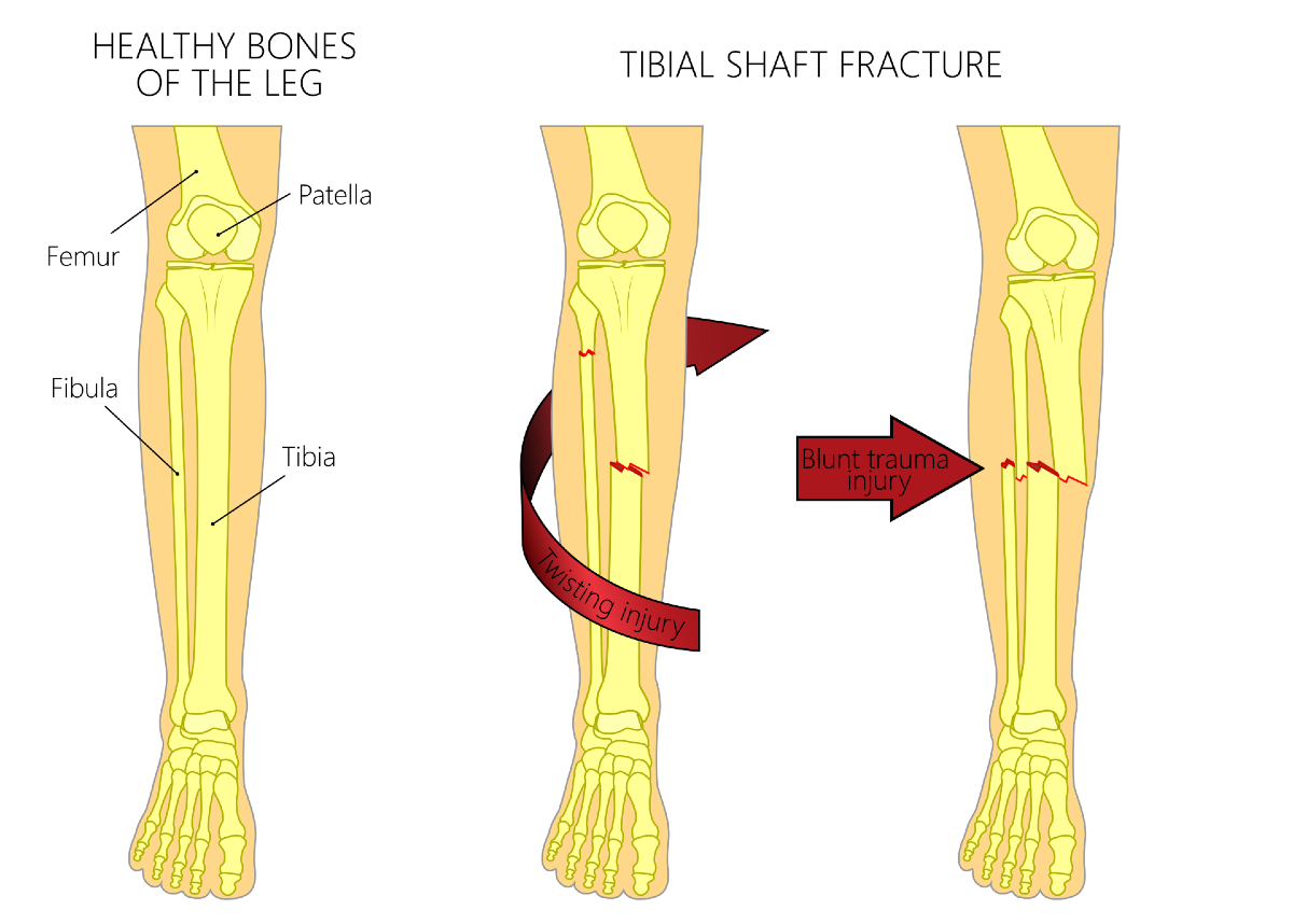 Tibia Or Fibula Fractures Indiana Slip And Fall Lawyers